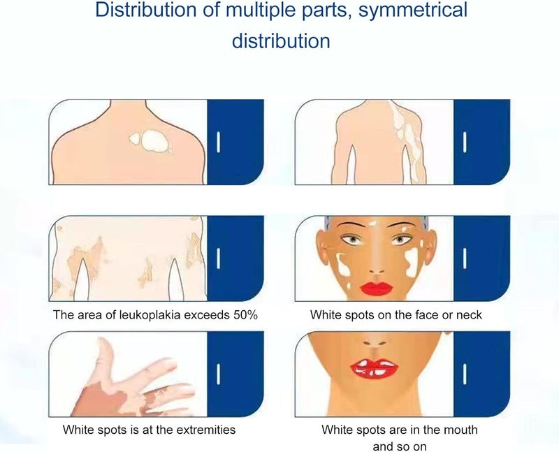 woobles UV Phtotherapy Light, Leukoplakia Promoting Blackening Vitiligo Lamp, Handheld Foldable UV Vitiligo Light for Home Use - Image 5